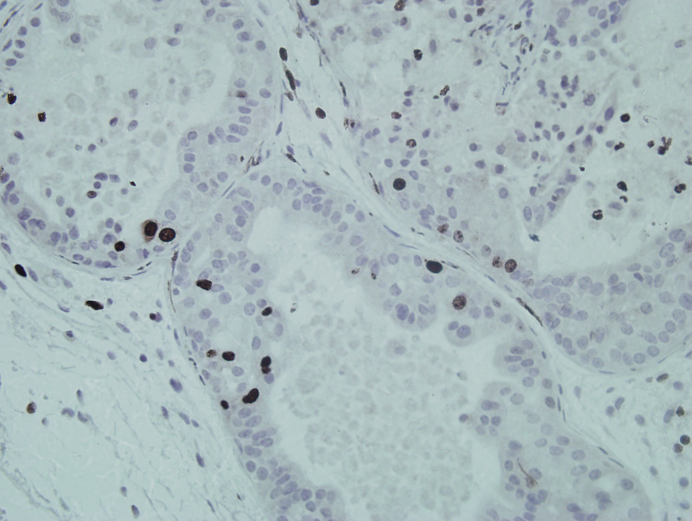 Tumor de próstata de modelos murinos preclínicos y en los que se ha eliminado el gen METTL1