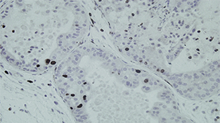 Tumor de próstata de modelos murinos preclínicos y en los que se ha eliminado el gen METTL1  