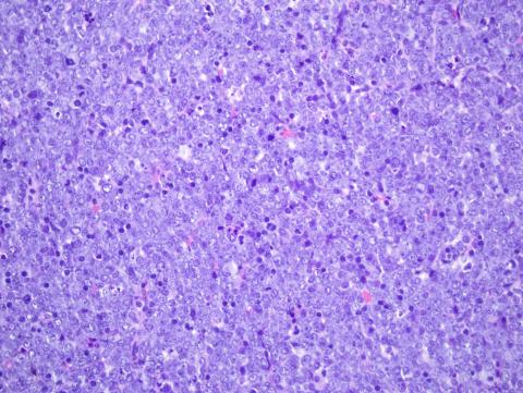 Histología de un nódulo linfático de un ratón con leucemia linfoblástica aguda 